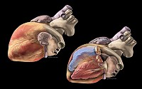 Human Heart - Oblique views of normal human heart showing external anatomy and internal structures (ventricles, valves).